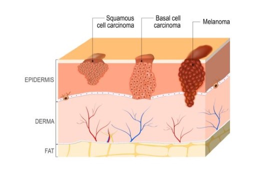 Rakovina kože sa primárne delí na 3 rôzne typy, kedy rozdiel je vždy v hĺbke kožného útvaru